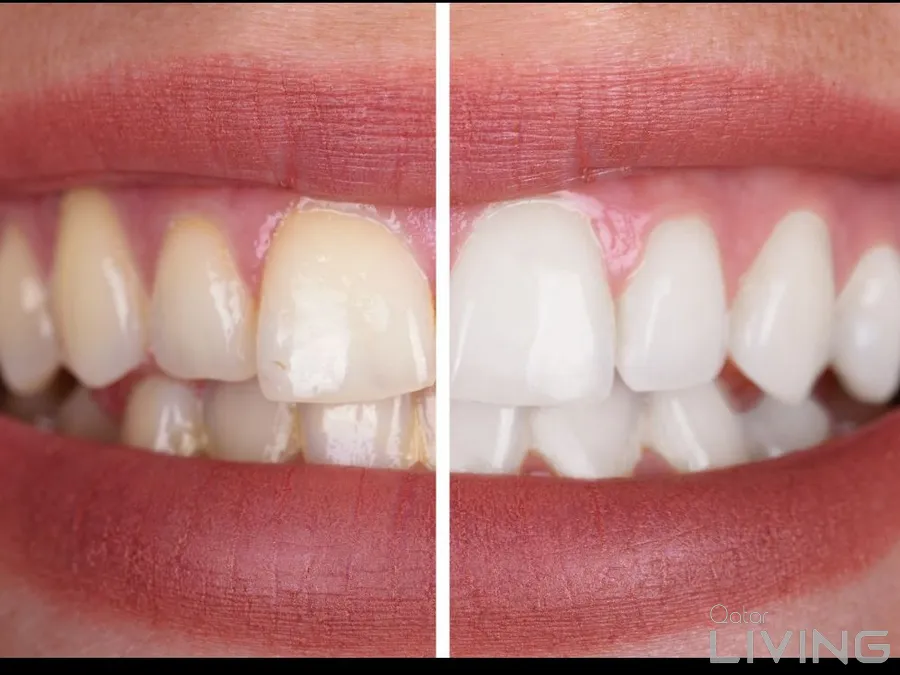 20% Off - Dental Cleaning & Polishing (Simple)